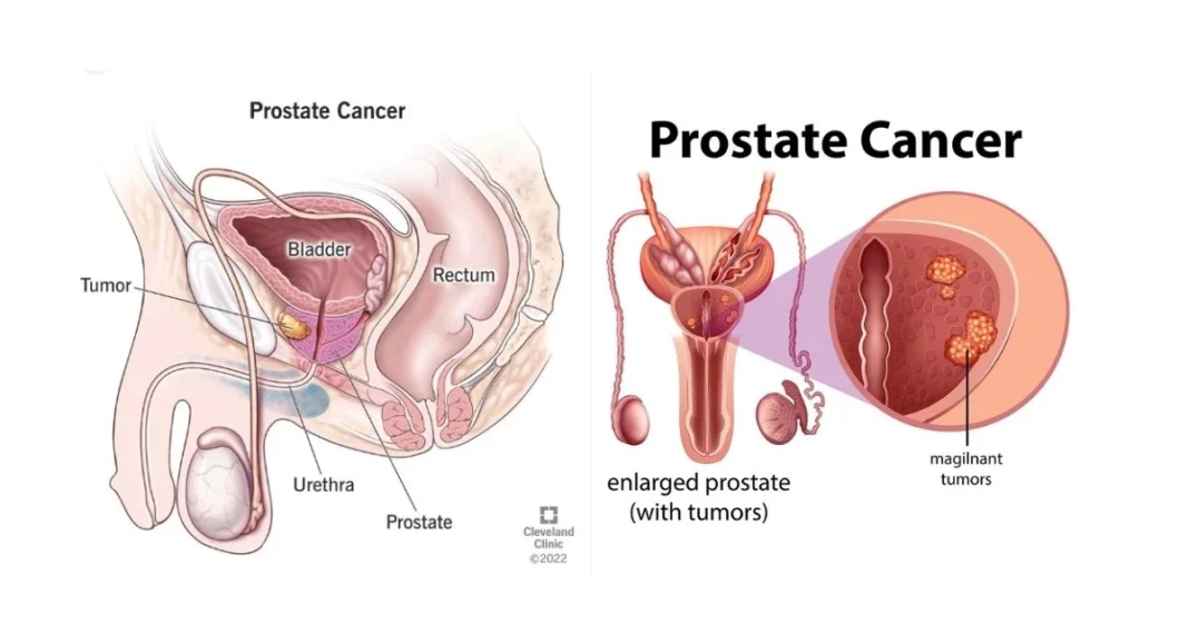 How Can I diagnose and cure Stage 4 Prostate Cancer survival rate?
